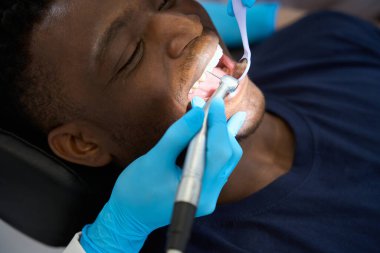 Kadın dişçi ağız aynasına bakıyor ve Afrikalı Amerikalı bir hastanın boşluğunu doldurmadan önce diş çürüğünü çıkarmak için diş matkabıyla çalışıyor.