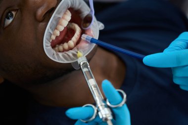 Yakın plan stomatologlar dişin etrafına anestezi yaparken hemşireler ağzında ayna ve emme aleti tutuyorlar.