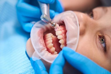 Genç bir kızın dişlerini parlatma süreci, özel bir tutkal kullanarak.