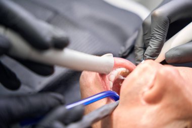 Profesyonel dişçilerden oluşan makro yakın çekim ekibi erkek dişlerini tedavi ediyor, ultrasonik pulluk ve tükürük püskürtücü kullanarak tartar ve plağı çıkarıyor, estetik dişçilik...