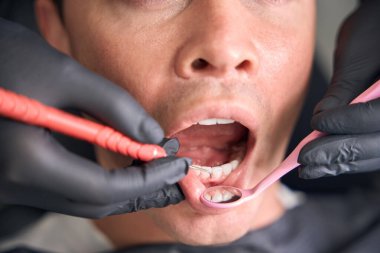 Deneyimli dişçi, erkek hasta dişinin durumunu kontrol ederken ağız aynasına bakıyor ve doktor randevusunda, curette kullanarak, erkek yüzünün yakın plan fotoğrafını çekiyor.