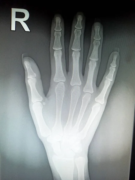 X-ray of the bones of the right hand of a young woman