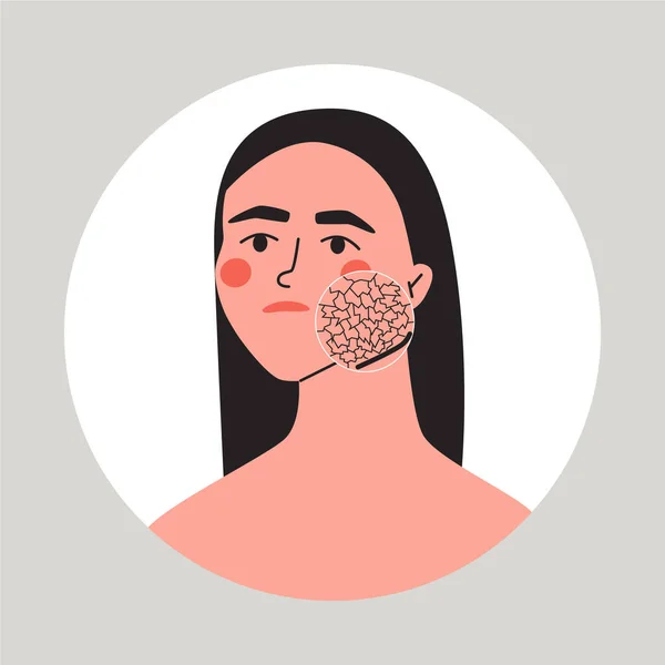 乾燥した顔の皮膚を持つ若い女性 皮膚の問題を示すズーム円 スキンケアと若返りの概念 平面ベクトル図 — ストックベクタ