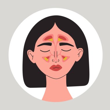 Sinüzitten muzdarip genç kadınlar. Sağlık sorunu olan bir kadın. Paranasal ve frontal sinüslerde mukoza zarı iltihaplanması. Düz vektör tıbbi illüstrasyon.