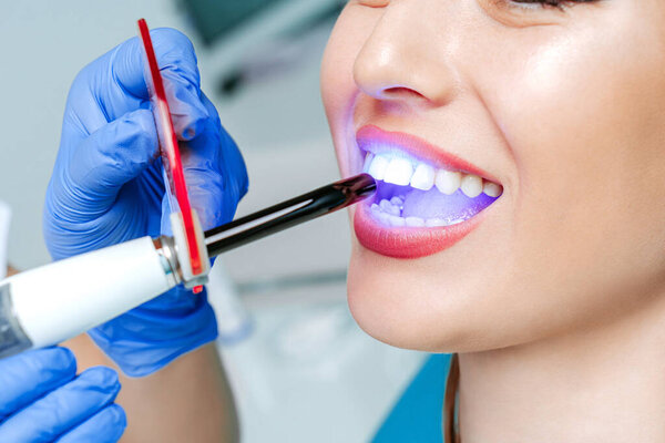 Врач стоматолог отбеливает зубы молодой привлекательной пациентке в стоматологической клинике. Руки доктора дантиста с медицинскими инструментами. Зубная концепция