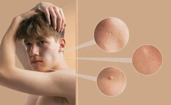 Oily Skin Male Problem Acne Blackhead Pustule Papule Enlarged Pores — Stock Photo, Image