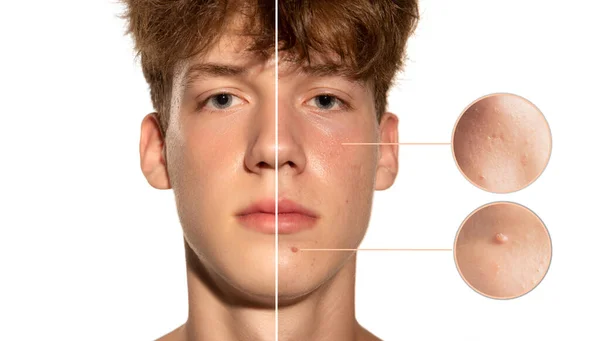 Fettiges Hautproblem Akne Mitesser Pusteln Papeln Vergrößerte Poren Collage Eines — Stockfoto