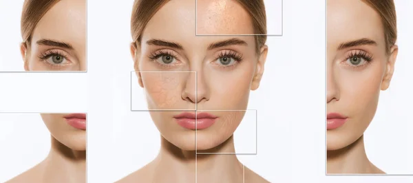 Female Skin Problems Close Beautiful Brunette Woman Facial Diseases Acne — Stock Photo, Image
