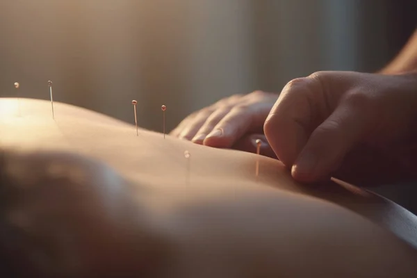 Acupuncture treatment with needles inserted into skin, hands resting on top