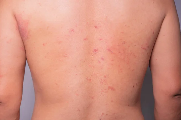 man\'s back was covered with many red wounds. insect allergy full back rash skin disease