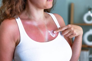Genç bir kadın güneş yanığı cildine nemlendirici sürüyor. Güneş kremi kullanmadığı için bir kadının göğsünde güneş yanığı var.