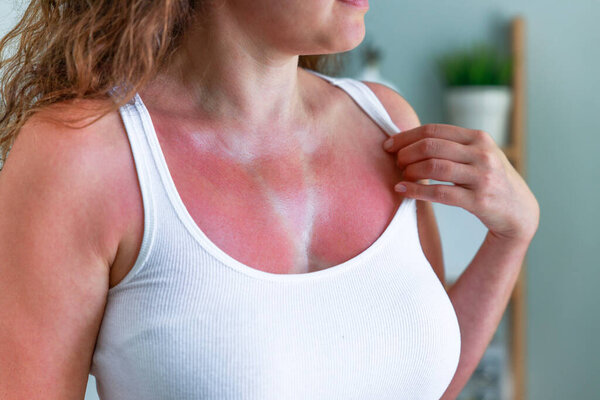 Женщина с солнечными ожогами на коже со следами купальника. Загорелая кожа на груди женщины из-за не использования крема с солнцезащитным кремом