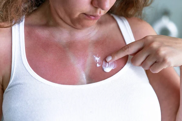 Junge Frau Trägt Feuchtigkeitscreme Auf Sonnenverbrannte Haut Auf Sonnengebrannte Haut — Stockfoto