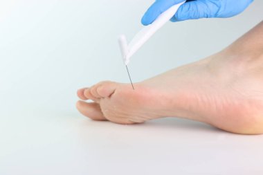 Eldivenli el, ayak ucunda akupunktur iğnesi tutuyor.
