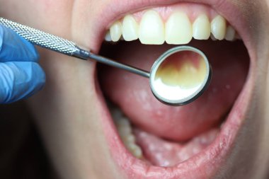 Aynayla diş muayenesine yakın çekim