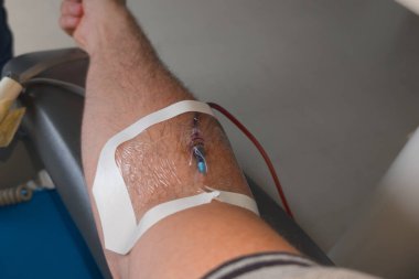 Damardan insan kolu üzerine ilaç damlatılıyor. Koluna serum takılıyor.