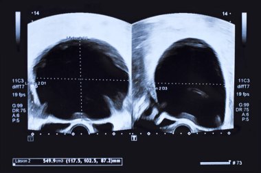 Ultrasound image of large round cyst in lower abdomen of woman printed on a piece of paper clipart