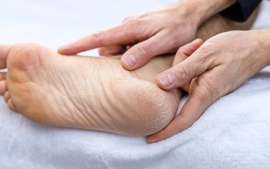Erkek ayağı topuklarda kuru deri. Seçici odaklanma. İnsanlar.