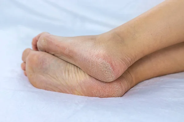 Weibliche Füße Trocknen Die Haut Auf Den Fersen Selektiver Fokus — Stockfoto