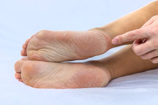 Weibliche Füße Trocknen Die Haut Auf Den Fersen Selektiver Fokus — Stockfoto