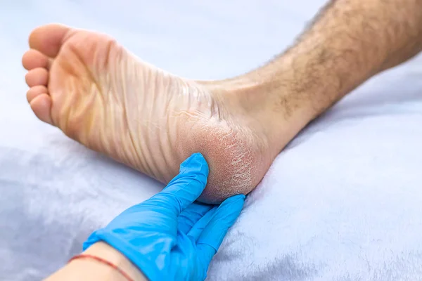 Männliche Füße Trocknen Die Haut Auf Den Fersen Selektiver Fokus — Stockfoto