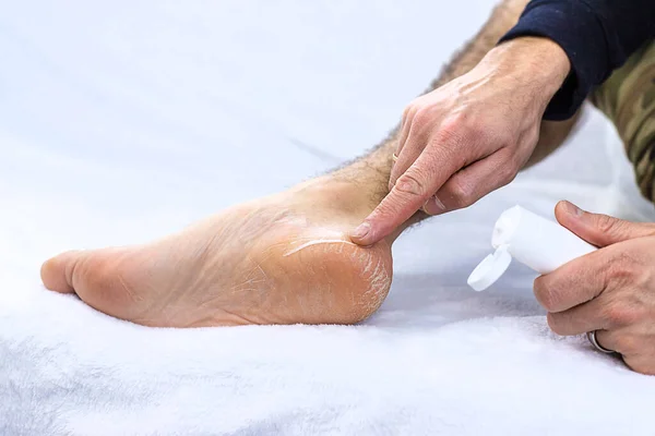 Männliche Füße Trocknen Die Haut Auf Den Fersen Selektiver Fokus — Stockfoto
