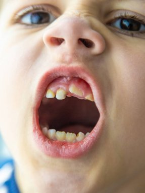 Çocuğun kötü dişleri var. Seçici odaklanma. çocuk.