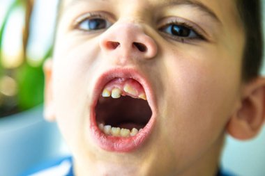 Çocuğun kötü dişleri var. Seçici odaklanma. çocuk.