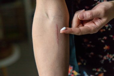 Bir kadının elinde bir çizik. Seçici odaklanma. insanlar.