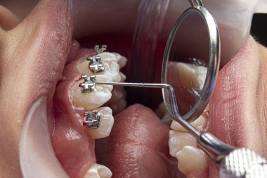 Self-ligating brackets an orthodontic technique
