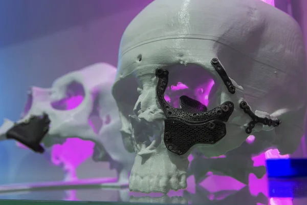 3Dプリント技術を使用して作られたインプラントを持つ人間の頭蓋骨のマダム — ストック写真