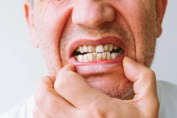 teeth with lot of tartar, plaque. malocclusion, crooked teeth. concept of unhealthy teeth in need of treatment, braces, treatment at orthodontist. Close-up portrait of man showing teeth with tartar