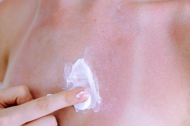 Güneş yanığı, kırmızı lekeler, alerjik reaksiyon. Ultraviyole radyasyona karşı kozmetik krem sürüyorum.