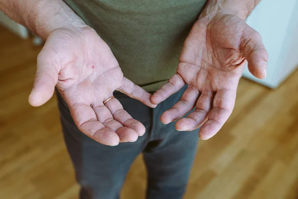 man demonstrates palms hands skin marbling syndrome, blood vessels on skin of red color. Hands man skin marbling syndrome. Arms muscular, big, hard workers, laborer