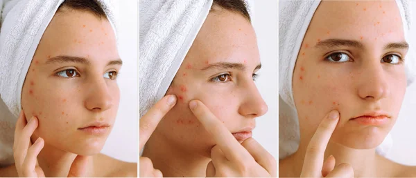 Portrait Young Woman Teenager Girl White Towel Head Teenage Acne — Stock Photo, Image