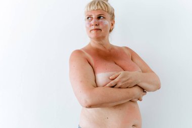 Tombul orta yaşlı kadın büyük göğüsleri örtüyor. Göğüs büyüklüğünde bir kadın, göğsünde güneş yanığı var, ultraviyole koruma. Koruyucu sprey kadın derisinde kullanılır. Göğsünde güneş yanığı olan kadın..