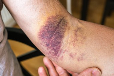 Intense bruising from dislocated elbow joint, ligament damage on man, muscle, ligament sprain in sports, inflammation, injury. Bruise, bruise, veins, blood vessels, close-up on injured arm muscular 