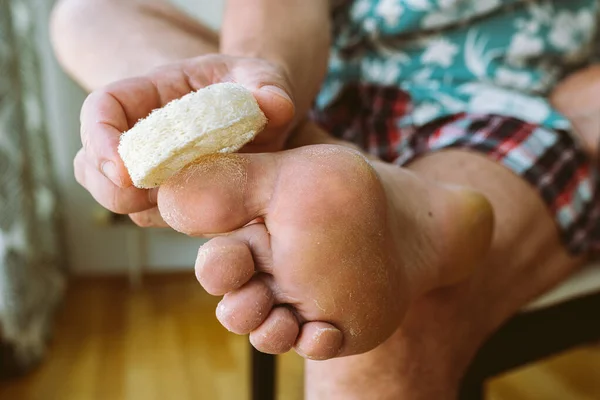 Man Makes Peeling Skin Legs Removes Dry Cracked Skin Soles — Stock Photo, Image