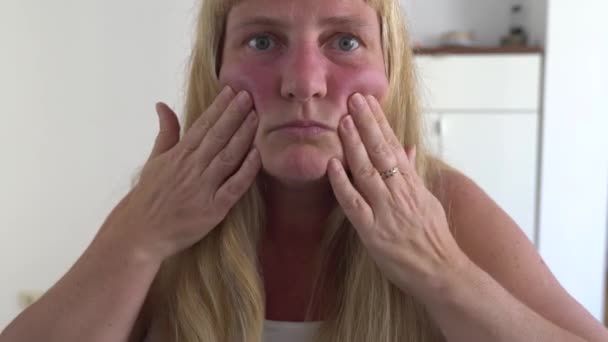 Middle Aged Woman Blonde Plump Touches Reddened Face Swollen Allergies — Stock Video