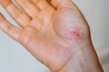 Uçuk isiliğinden etkilenen kadınlar. Viral hastalık, cilt kızarıklığı, kabarcıklar