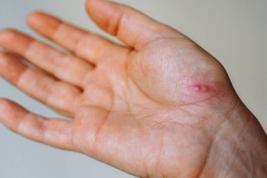Uçuk isiliğinden etkilenen kadınlar. Viral hastalık, cilt kızarıklığı, kabarcıklar