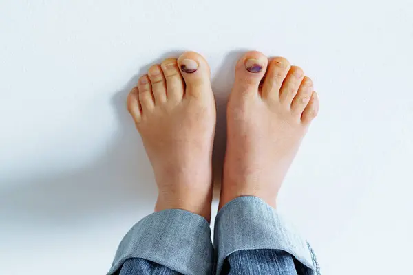 barefoot female feet with bruise on big toe nail due to tight uncomfortable shoes on white background. Swelling of feet in shoes.Foot fatigue