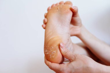 Kadın ayağının kurumuş, pul pul derisi. Sağlık sorunları, cilt bakımı, protein eksikliği, kolajen,