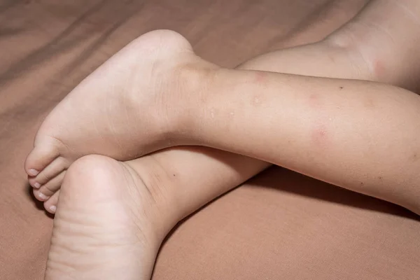 Baby Schläft Mückenstiche Ins Bein — Stockfoto