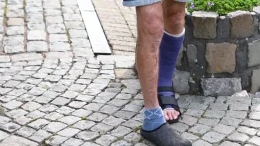 Adam kayalık bir yolda yürüyor mor fiberglas bir alçıda kırık bir bacakla, ayakları özel yürüyen bir sandalette, etkin yaşam tarzı konsepti, hareketsiz kasları eğitmek,
