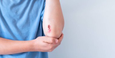 Unrecognizable child shows his elbow with noticeable abrasion and wound on elbow, experiencing pain from scratch and fresh injury requiring attention and possible medical treatment,copy space