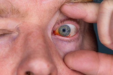 Gözdeki damar zedelenmiş. İnsan gözünde kan. El feneriyle kapatılmış.. 