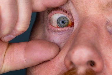 Gözdeki damar zedelenmiş. İnsan gözünde kan. El feneriyle kapatılmış.. 