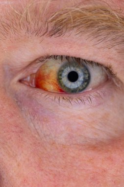 Gözdeki damar zedelenmiş. İnsan gözünde kan. El feneriyle kapatılmış.. 