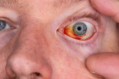 Gözdeki damar zedelenmiş. İnsan gözünde kan. El feneriyle kapatılmış.. 